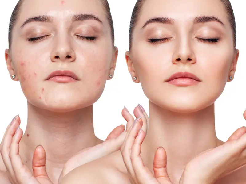 Acné et peau sensible: Pourquoi le lait d'ânesse est votre meilleur allié